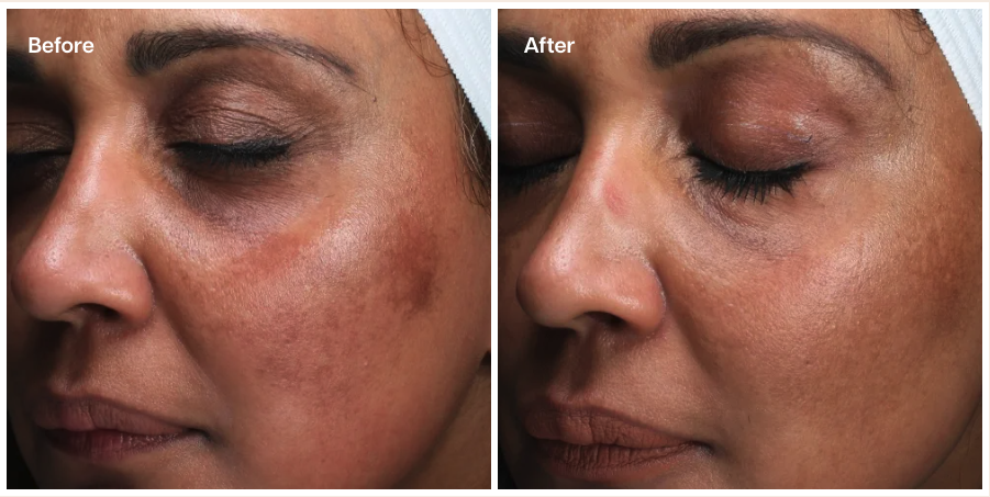 A side-by-side "Before and After" comparison of a person's face. The "Before" image shows visible hyperpigmentation and uneven skin tone, particularly around the cheeks and under-eye area, while the "After" image displays a significantly brighter and more even complexion with reduced dark spots.