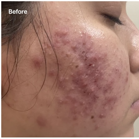 A close-up "Before" image of a person's cheek and jawline, showing severe inflamed acne, redness, and numerous blemishes with uneven skin texture.
