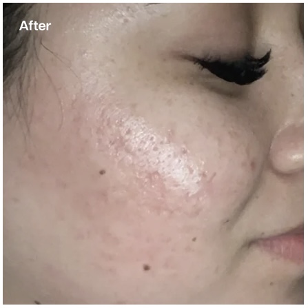 A close-up "After" image of a person's cheek showing significantly reduced acne, less redness, and improved skin texture, with minimal visible blemishes and a smoother appearance.