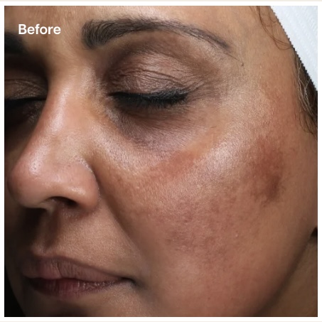A close-up "Before" image of a person's face with dark skin and closed eyes, showing significant hyperpigmentation, including dark patches and uneven skin tone, particularly on the cheek and around the eyes.