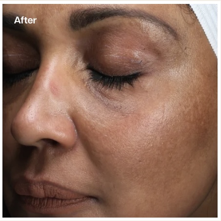 A close-up "After" image of a person's face with dark skin and closed eyes, showing a more even skin tone and smoother texture around the cheek and eye area, indicating improved clarity and reduction in hyperpigmentation.