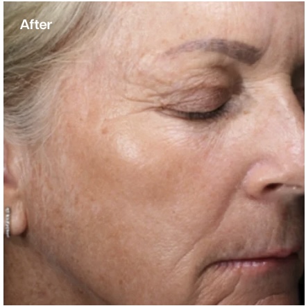 A close-up "After" image of an older person's face, showing smoother skin around the eyes and cheeks with a more even tone, suggesting a reduction in fine lines and hyperpigmentation.