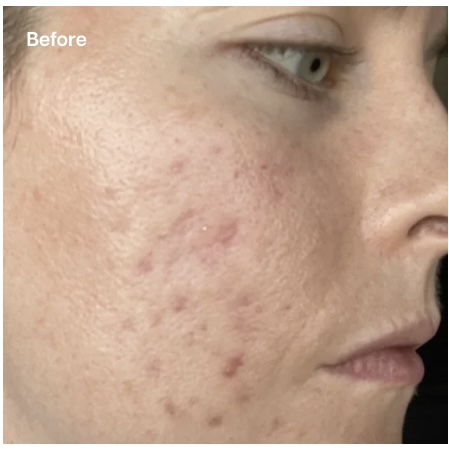 A close-up "Before" image of a person's face, showing visible acne marks, redness, and uneven skin texture on the cheek and jawline.