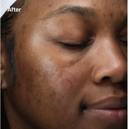 A close-up "After" image of a person's face with dark skin and closed eyes, showing a more even skin tone and smoother texture around the cheek and eye area, indicating improved clarity and reduction in hyperpigmentation.